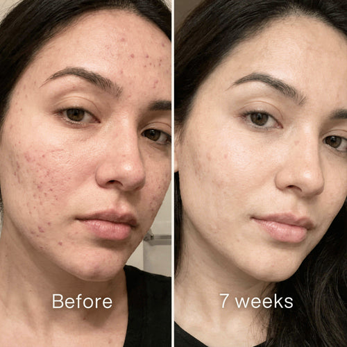 Clinical Acne Scare Repair Stick
