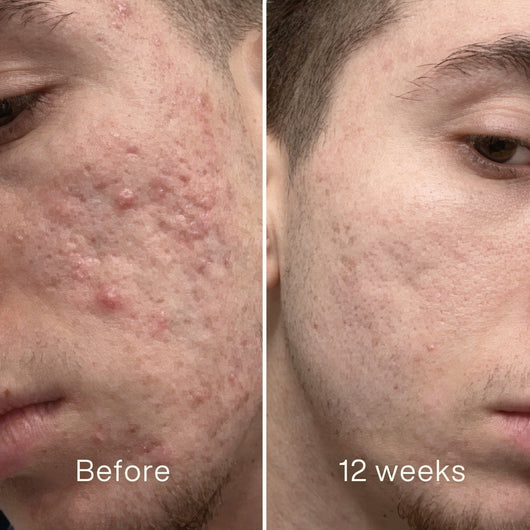 Clinical Acne Scare Repair Stick